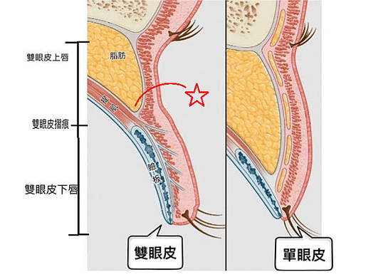 【雙眼皮重修/眼皮下唇乾瘪/雙眼皮太雙眼皮薄】雙眼皮下唇乾癟原因及處理方式-作者Dr.沈筠惇