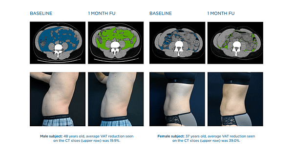 02News-Emsculpt-offal-fat-decline.png