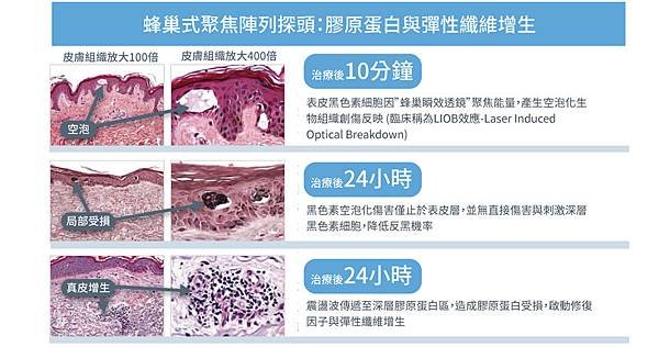 acupulse超脈衝雷射痘疤雷射痘疤治療除凹疤彤曜診所沈育如醫師皮膚專科高雄醫美推薦09.jpg