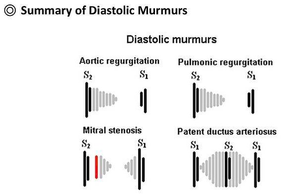 Diastolic murmur統整