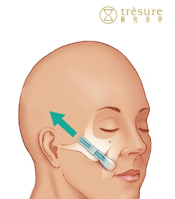 3.微創拉皮緊緻4-02.jpg