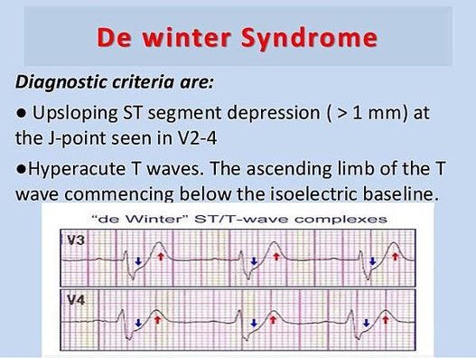 stemi-equivalents-11-638.jpg