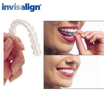 pic_invisalign.jpg