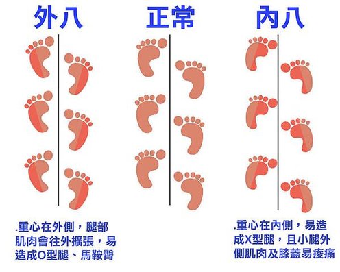 走路姿勢造成腿部外觀圖.jpg