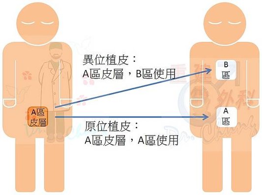 陰莖注射凡士林/石蠟的處理架構(The treatment 