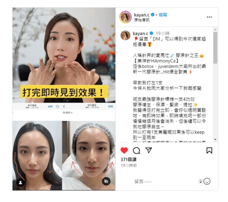 一針變美神？HarmonyCa美神針 真係咁堅？