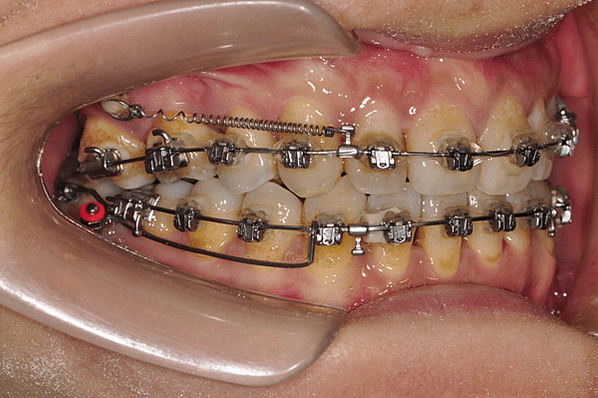 @齒顎矯正每日一說~~0224 IZC miniscrew(