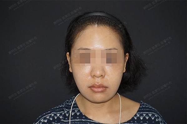 謝明吉 正顎手術 恢復週記