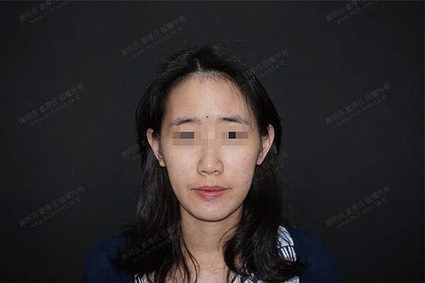 謝明吉 正顎手術 恢復週記