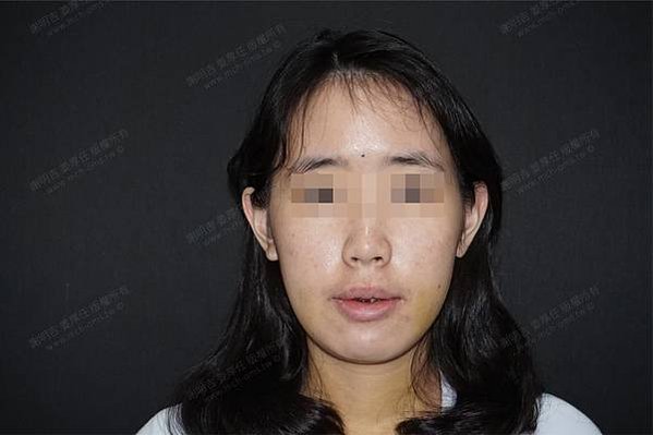 謝明吉 正顎手術 恢復週記