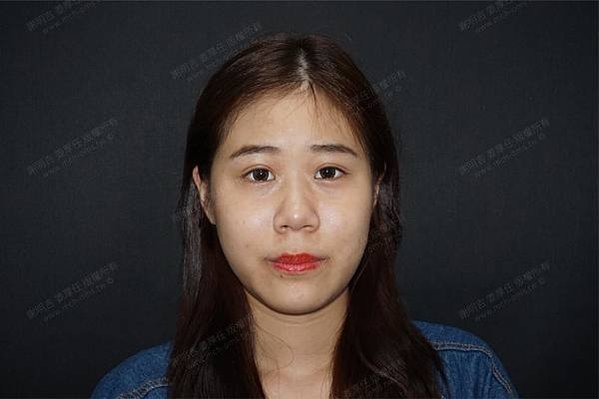 謝明吉 正顎手術 恢復週記