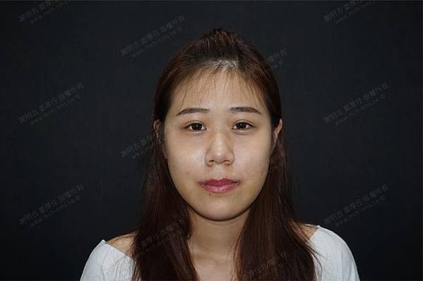 謝明吉 正顎手術 恢復週記