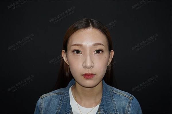 謝明吉 正顎手術 恢復週記