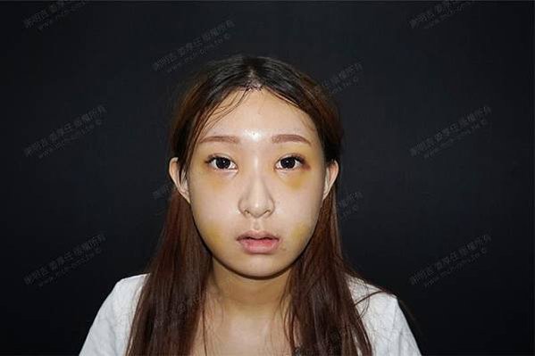 謝明吉 正顎手術 恢復週記