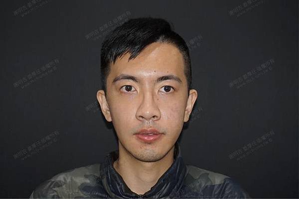 謝明吉 正顎手術 恢復週記