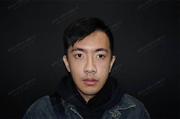 謝明吉 正顎手術 恢復週記