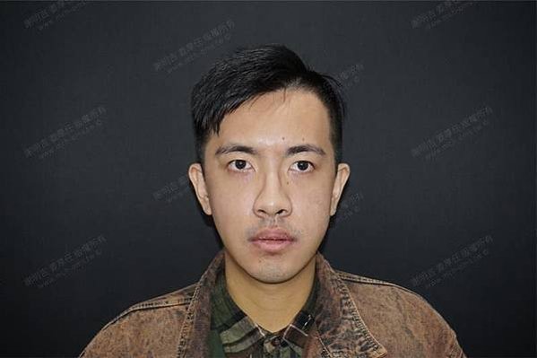 謝明吉 正顎手術 恢復週記