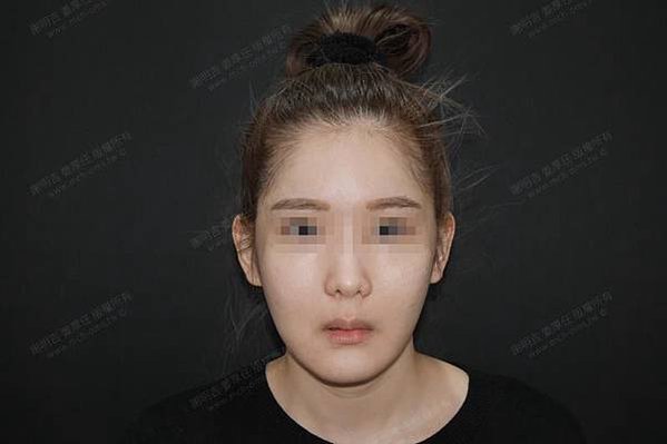 謝明吉 正顎手術 恢復週記