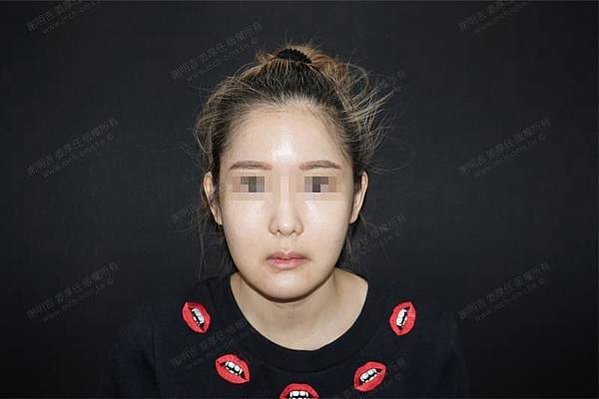 謝明吉 正顎手術 恢復週記