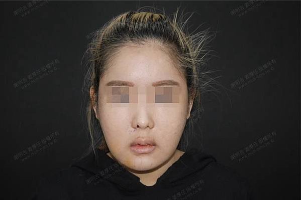 謝明吉 正顎手術 恢復週記