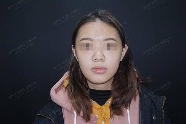 謝明吉 正顎手術 恢復週記