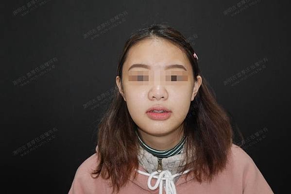 謝明吉 正顎手術 恢復週記