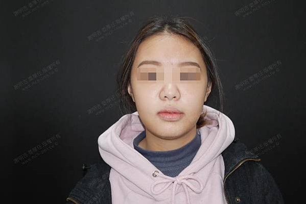 謝明吉 正顎手術 恢復週記