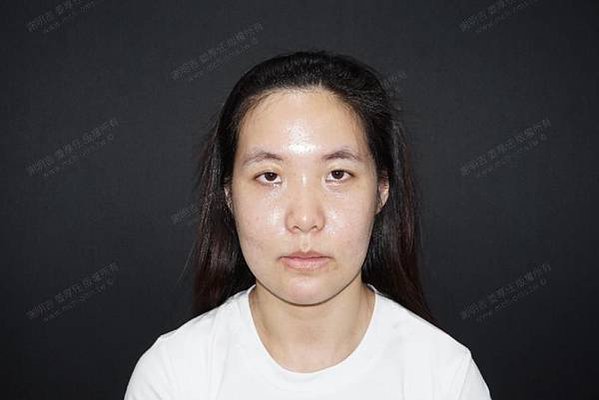 謝明吉 正顎手術 恢復週記
