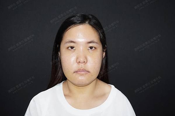 謝明吉 正顎手術 恢復週記