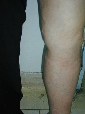 CEAP#swelling