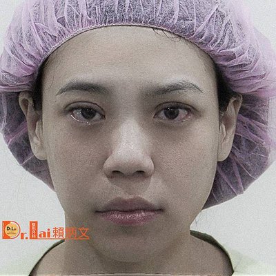縫雙眼皮立即效果