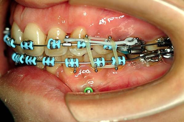 @齒顎矯正每日一說~~0226齒間骨釘(interdenta