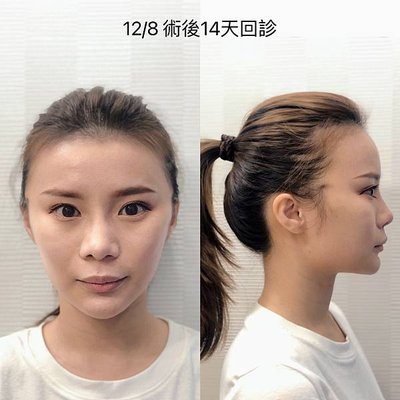 晶華醫美診所 台北埋線拉提推薦 張子倩醫師