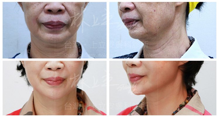 01-Double-chin-doctor-ShangLi-dermatologic-aesthetic-clinic (4).jpg