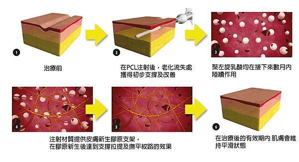 洢蓮絲ellanse聚己內酯依戀詩易麗適少女針奇蹟針液態拉皮二代童顏針膠原蛋白增生洢蓮絲費用價格洢蓮絲價位林上立上立皮膚科診所淚溝眼袋多少CC1CC打多少9.jpg