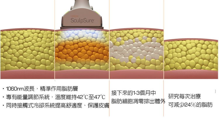 SculpSure體雕減肥減肥藥不好絲酷秀術後修復價格恢復期雷射體雕二極體冷凍溶脂減肥日記費用減肥食譜術後雷射溶脂局部平坦小腹塑身曲線雕塑林上立上立皮膚科診所 (2).jpg