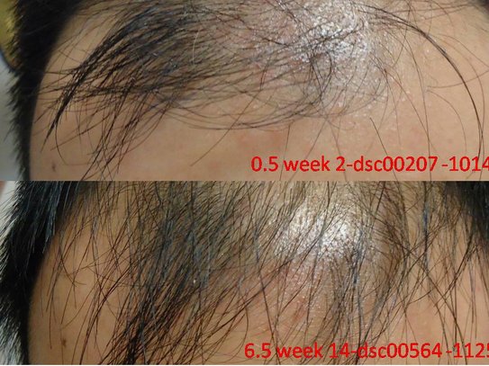 TREATMENT FOR FRONTAL HAIR LOSS FRONTAL  HAIR REGROWTH USEFUL OR NOT ?