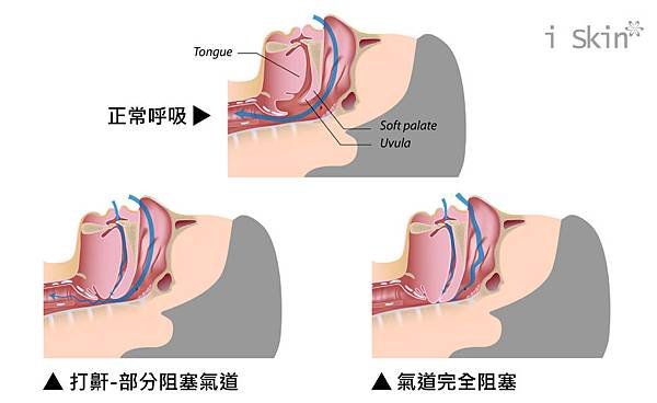 Chen-Doctor-Snoring-3