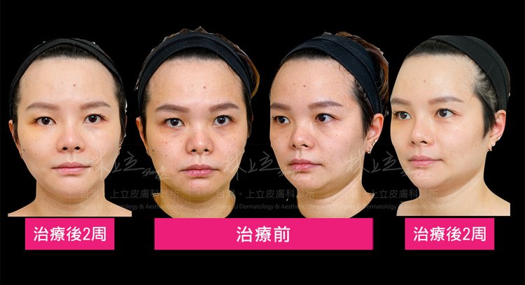 How-long-will-AestheFill-improve-the-depression-of-nasolabial-folds-to-see-the-effect.jpg