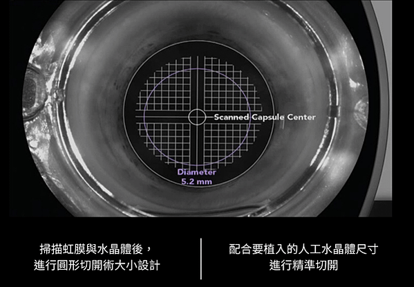 雷射多焦點白內障