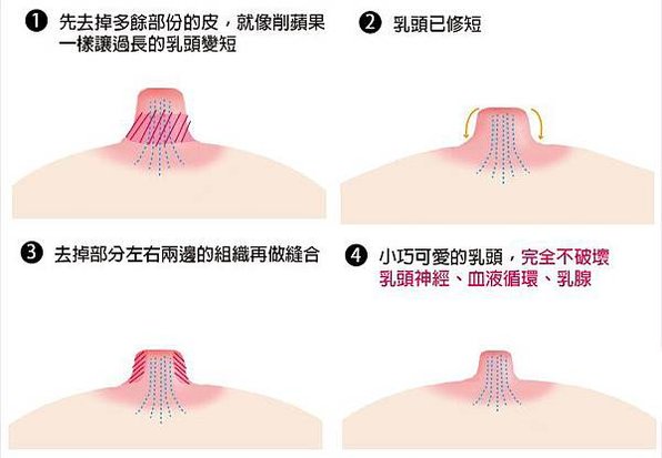 乳頭縮小手術示意圖