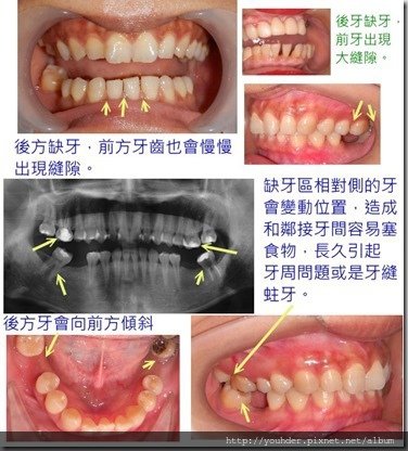 缺牙後遺症