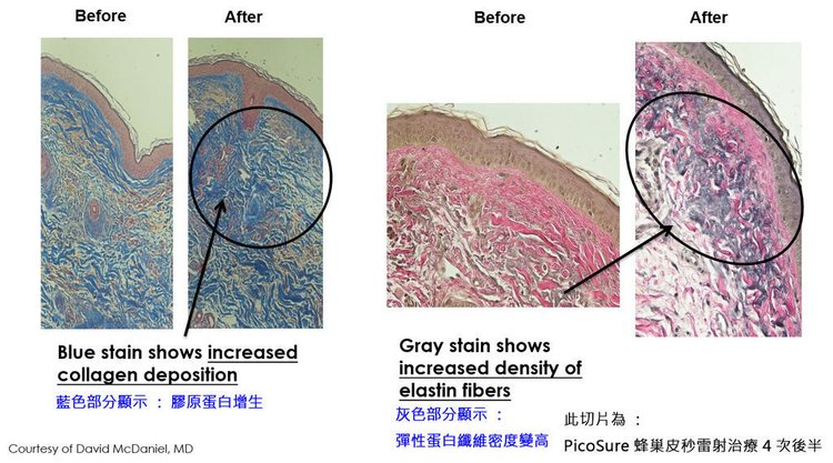 皮秒雷射毛孔皮秒雷射術後保養皮秒雷射凹洞皮秒雷射多久打一次755蜂巢皮秒雷射價格 04.jpg