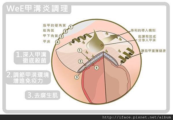 甲溝炎居家自我照顧:足部清潔 調理足部環境 根治甲溝炎