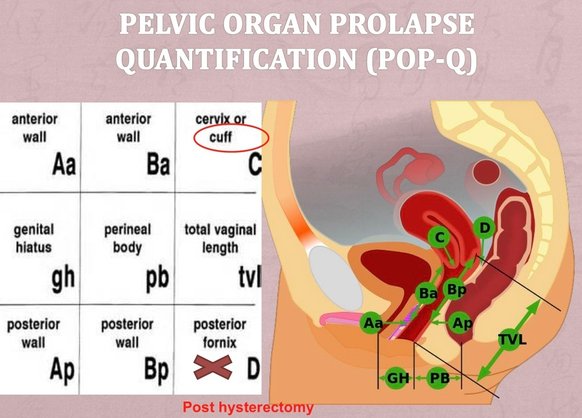 POP-Q.PNG