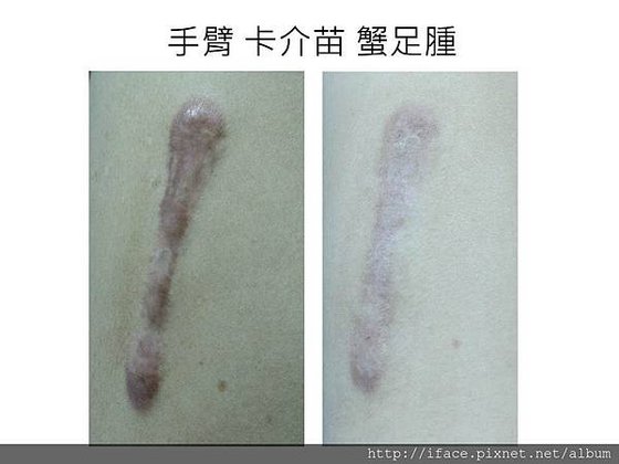 蟹足腫疤痕治療