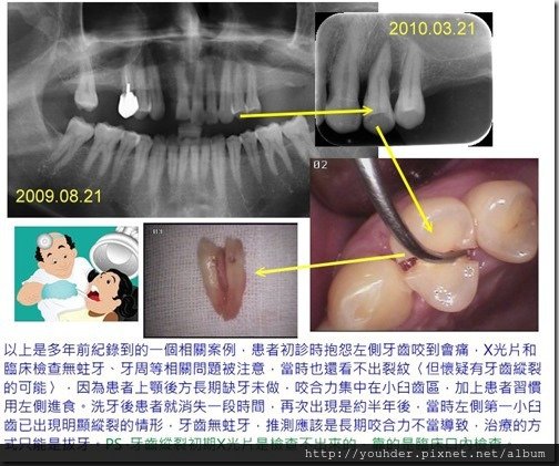 後方長期缺牙咬合力不當導致牙齒出現縱裂