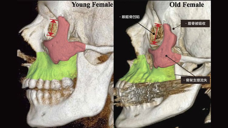 「年輕的骨架（左）」到「老化的骨架（右）」，體積明顯減少、退縮，支撐力也會因此變差。