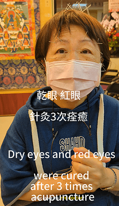 乾眼紅眼針灸3次痊癒 溫崇凱中醫針灸治療dry eyes