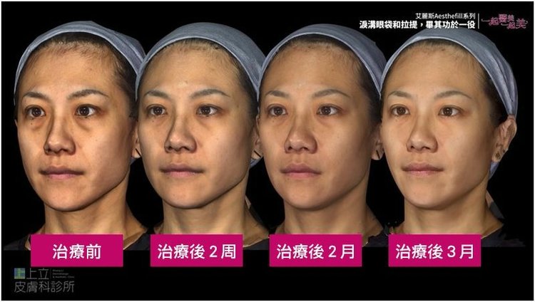 How-long-will-AestheFill-improve-the-depression-of-nasolabial-folds-to-see-the-effect (5).jpg